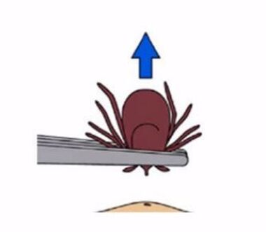 How to Remove a Tick Mechanicsville Pest Control Mechanicsville, VA